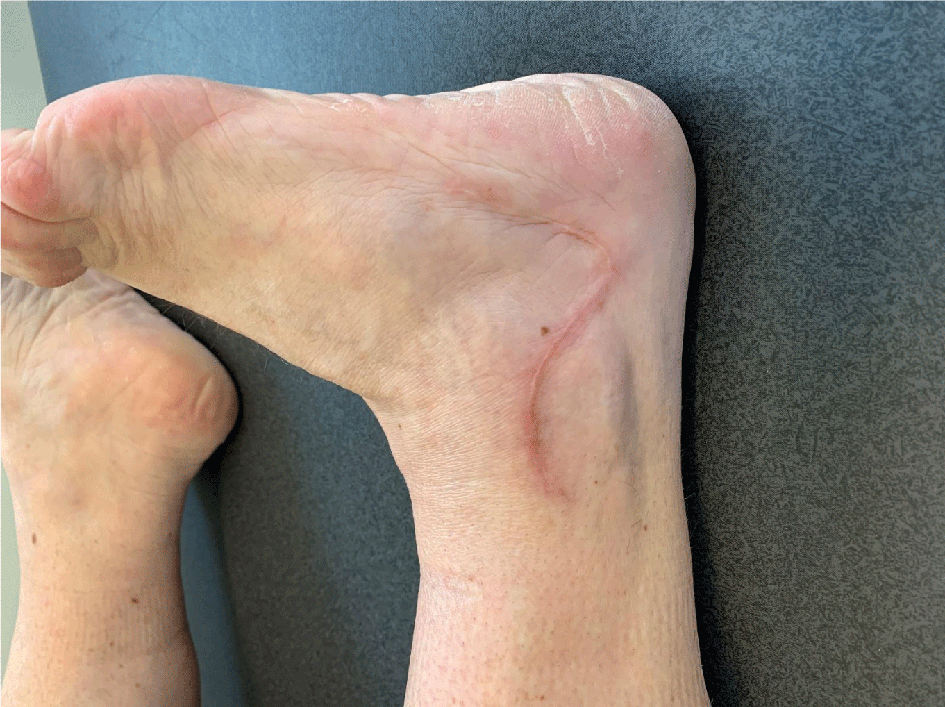 lateral ankle ligament reconstruction surgery