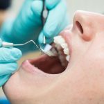 Wisdom Tooth Removal Singapore– The Overview